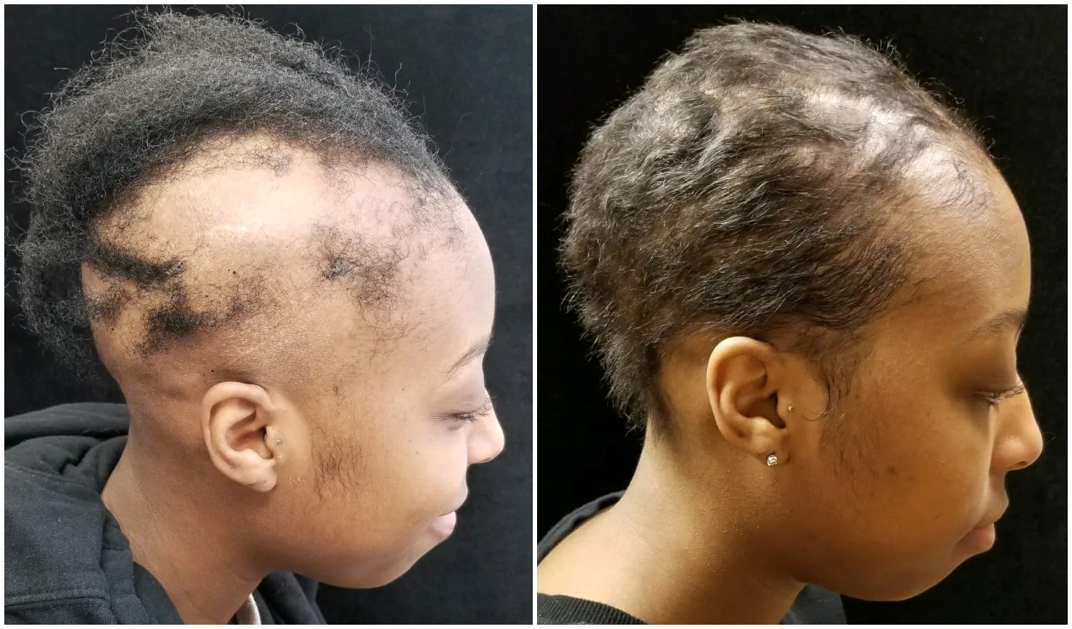 Does Endocrine Therapy Cause Hair Loss Does Endocrine Therapy Cause Hair Loss